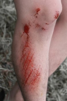 luka jatuh dari sepeda motor